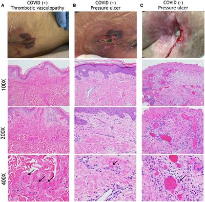 Abnormal thrombosis and neutrophil activation increase hospital-acquired sacral pressure injuries and morbidity in COVID-19 patients